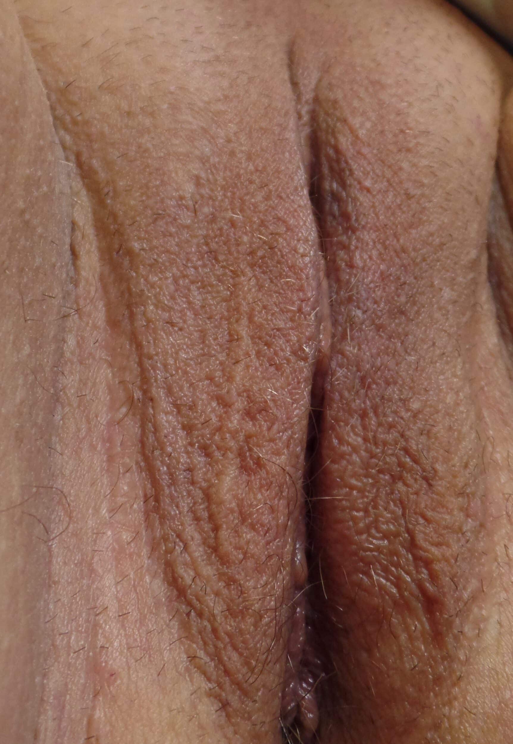After Image: Labiaplasty - right-front-oblique