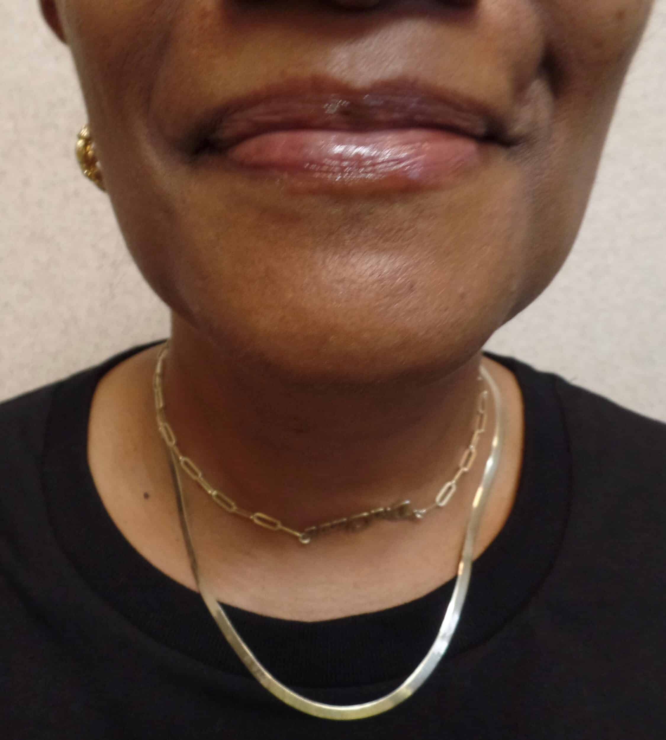 After Image: FaceTite Chin, Neck and Jowls - front