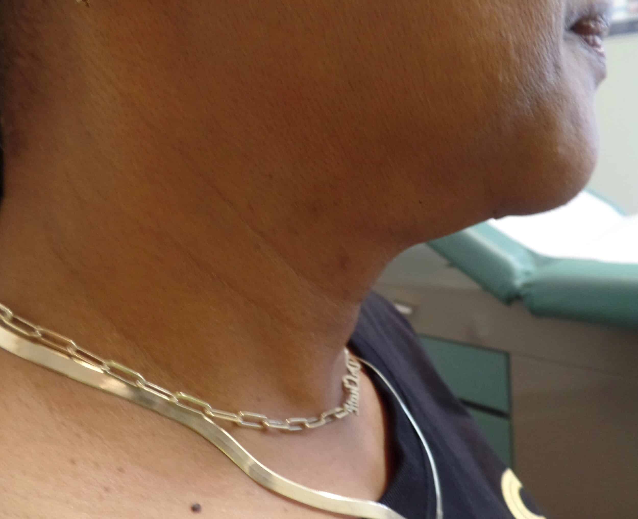 After Image: FaceTite Chin, Neck and Jowls - right-side