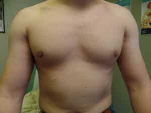 Gynecomastia treated with liposuction