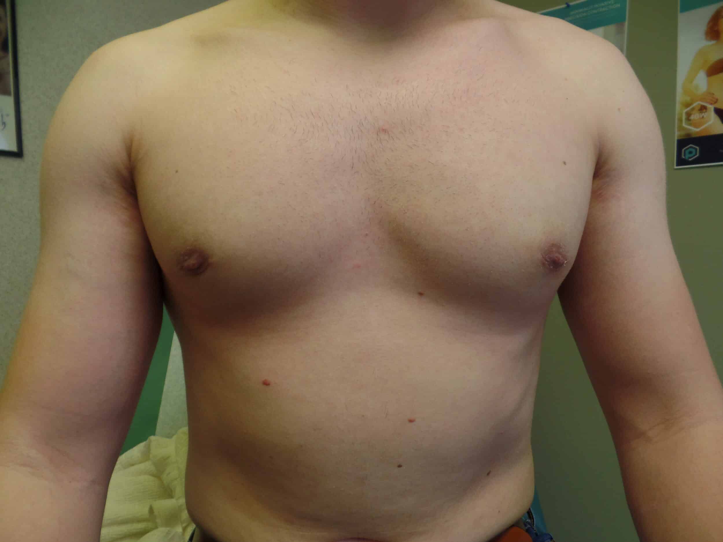 After Image: Gynecomastia treated with liposuction - front
