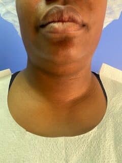Before Image: Liposuction of chin, neck and jowls - front