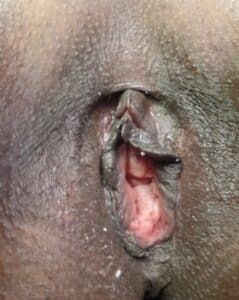 Before Image: Vaginoplasty