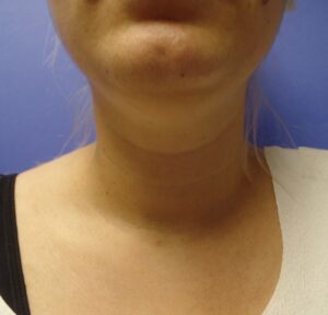 Before Image: Liposuction of face