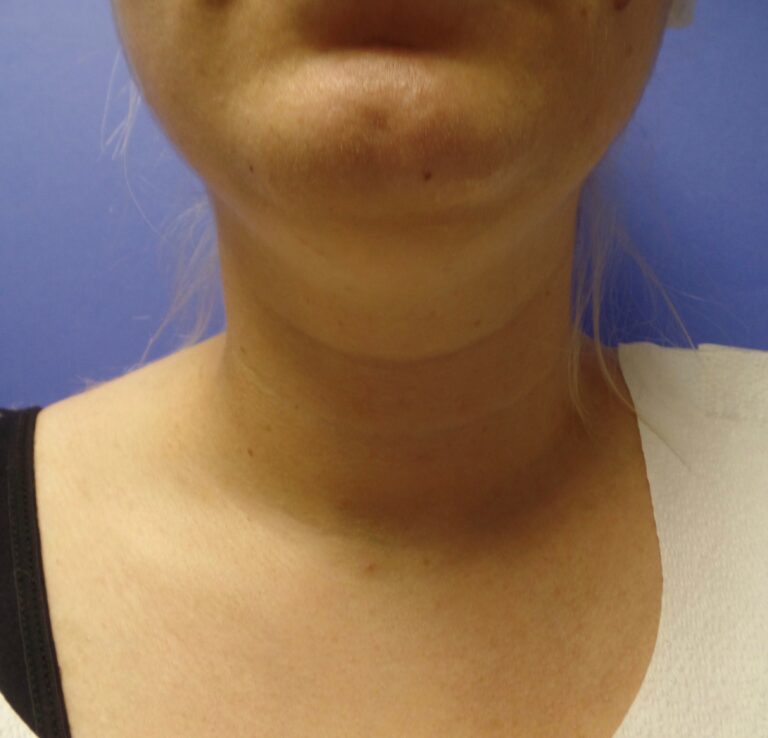 Before Image: Liposuction of face - front