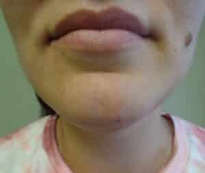 After Image: Liposuction of face