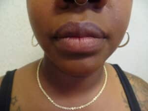 After Image: Liposuction of chin, neck and jowls