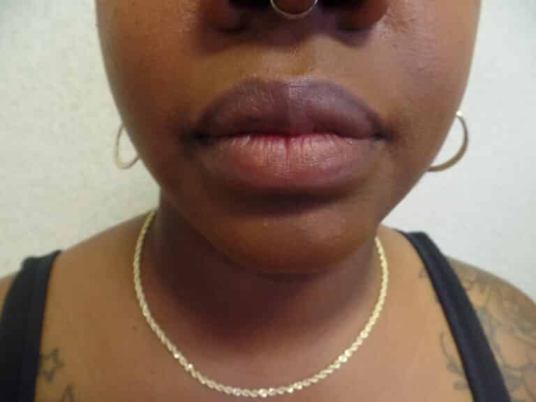After Image: Liposuction of chin, neck and jowls - front