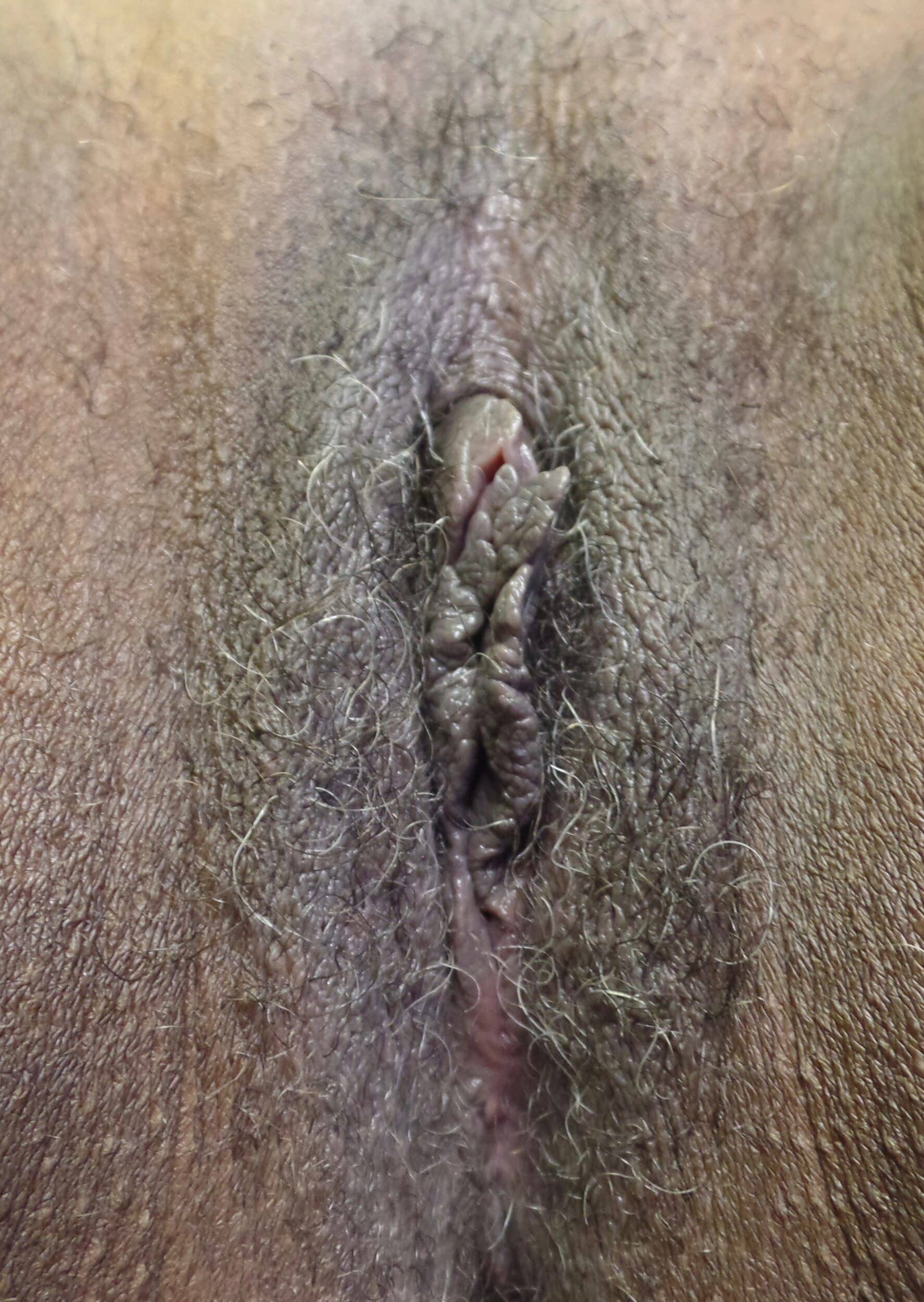 After Image: Vaginoplasty - front