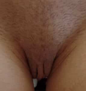 After Image: LABIAPLASTY