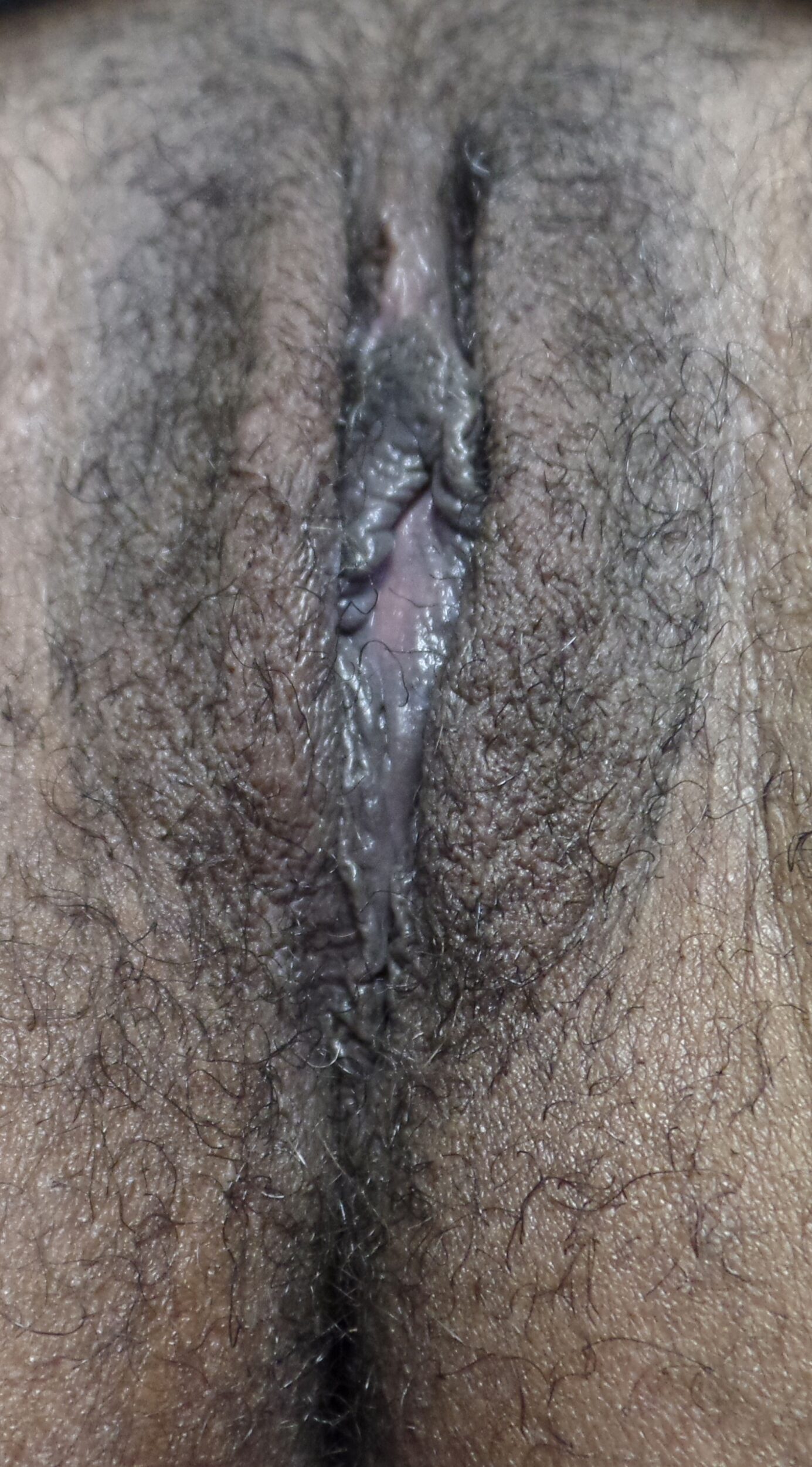 After Image: Vaginoplasty - right-front-oblique