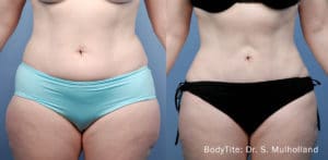 accutite combo post 1 1 1 300x300 1 sm bodytite 1a abdomen 24wks copy 1 300x147 1