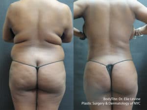 accutite combo post 1 1 1 300x300 1 rfal levine bodytite 1 300x225 1