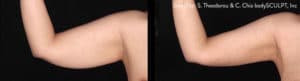 accutite combo post 1 1 1 300x300 1 cc st bodytite 1a arm notm 1 300x81 1