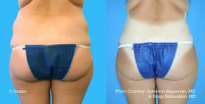accutite combo post 1 1 1 300x300 1 guillermo blugerman 12wk 1 300x153 1