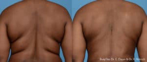 accutite combo post 1 1 1 300x300 1 edrr bodytite 4a 1 300x126 1