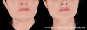 accutite combo post 1 1 1 300x300 1 st 1a accutite 3d frontcropped 25 ek 48hrs 1 300x106 1