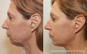 m8facetite bforley faceneck 56fem 300x187 1 m8facetite bforley faceneck 56fem 300x187 1