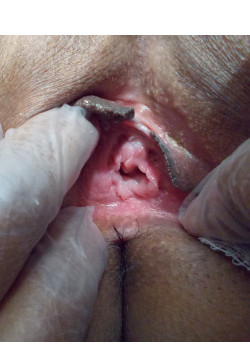 Before Image: Hymenoplasty - front