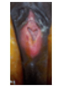 Before Image: Hymenoplasty - front