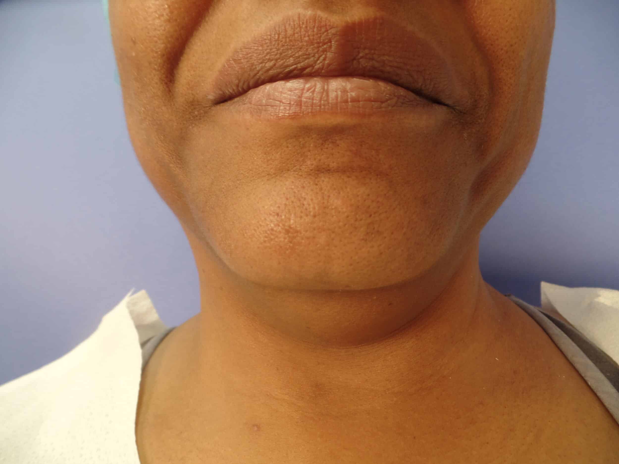 Before Image: FaceTite - front