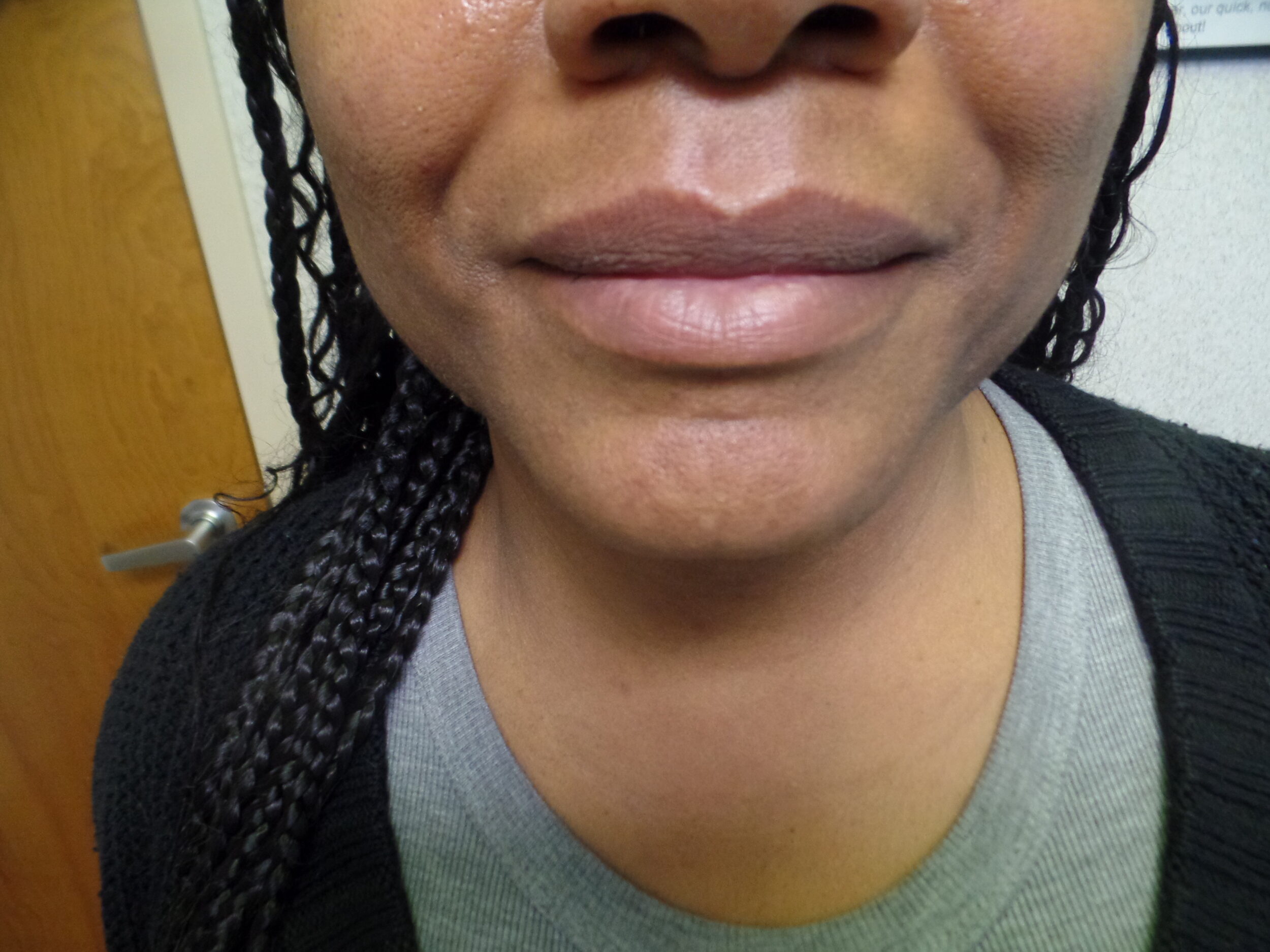 After Image: FaceTite - front