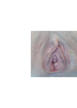 Labiaplasty – Case 2