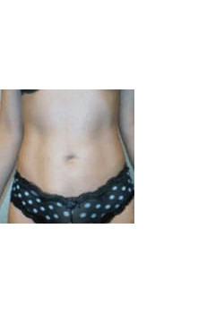 Tummy Tuck – Case 1