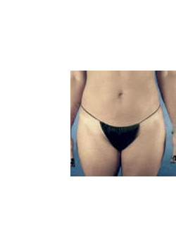 Tummy Tuck – Case 1