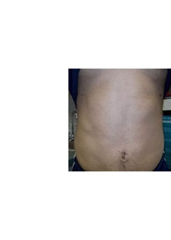 Tummy Tuck – Case 3