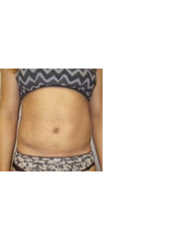 Tummy Tuck – Case 2