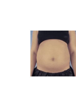 Tummy Tuck – Case 2