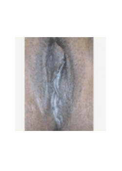 Vaginoplasty