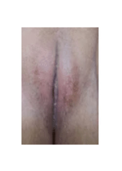 Labiaplasty