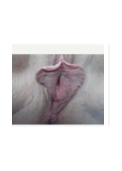 Labiaplasty