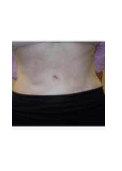 Tummy Tuck