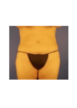 Tummy Tuck