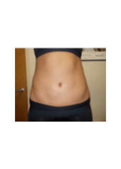 Liposuction