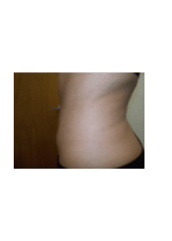 Liposuction