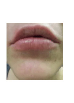 Filler
