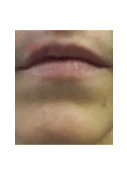 Filler