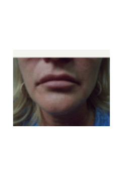 Filler