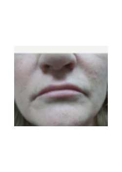 Filler