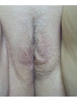 LABIAPLASTY