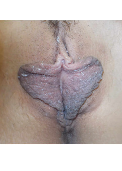 LABIAPLASTY