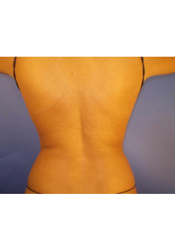 LIPOSUCTION 360 /BODYTITE