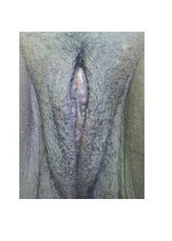LABIAPLASTY