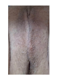 LABIAPLASTY