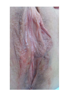 LABIAPLASTY