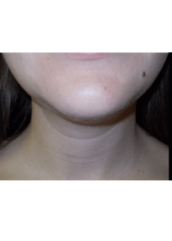 ACCUTITE/JAW LINE